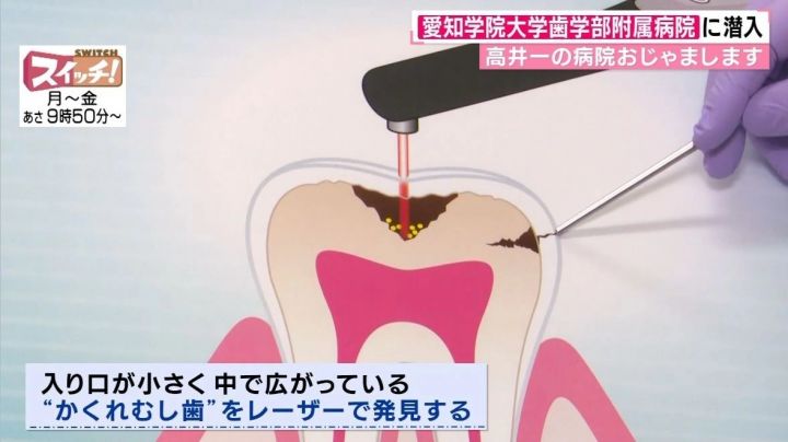 レントゲン撮らず 隠れ虫歯 も発見 歯科治療の最前線 痛くないレーザー治療から再生技術による歯周病治療まで 東海テレビnews
